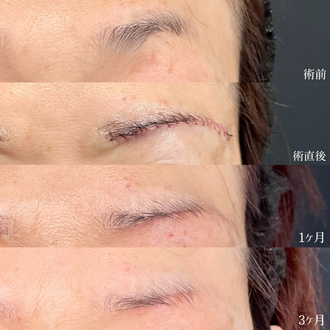 40代女性の眉下切開の傷跡のダウンタイム