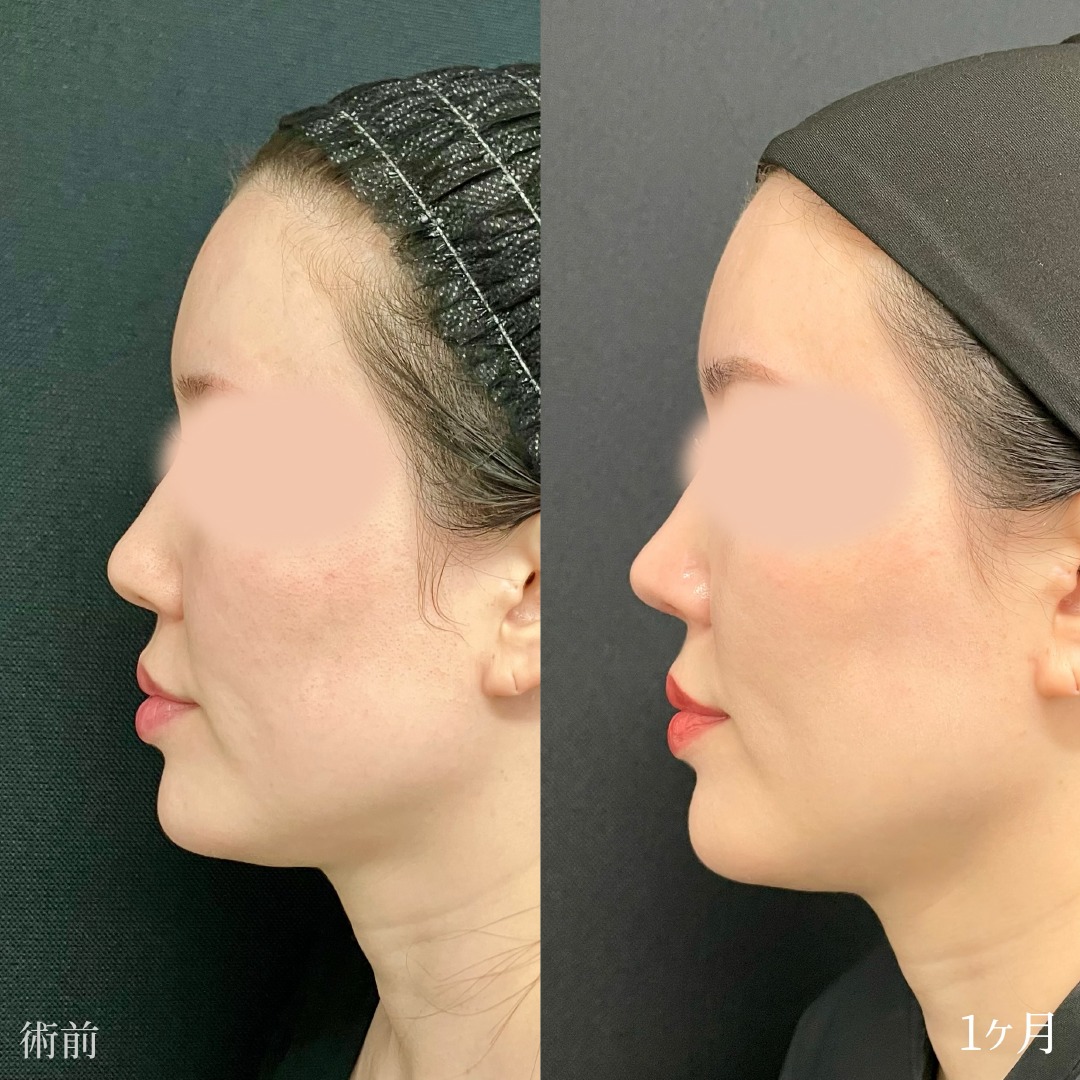 30代女性の鼻尖形成の症例