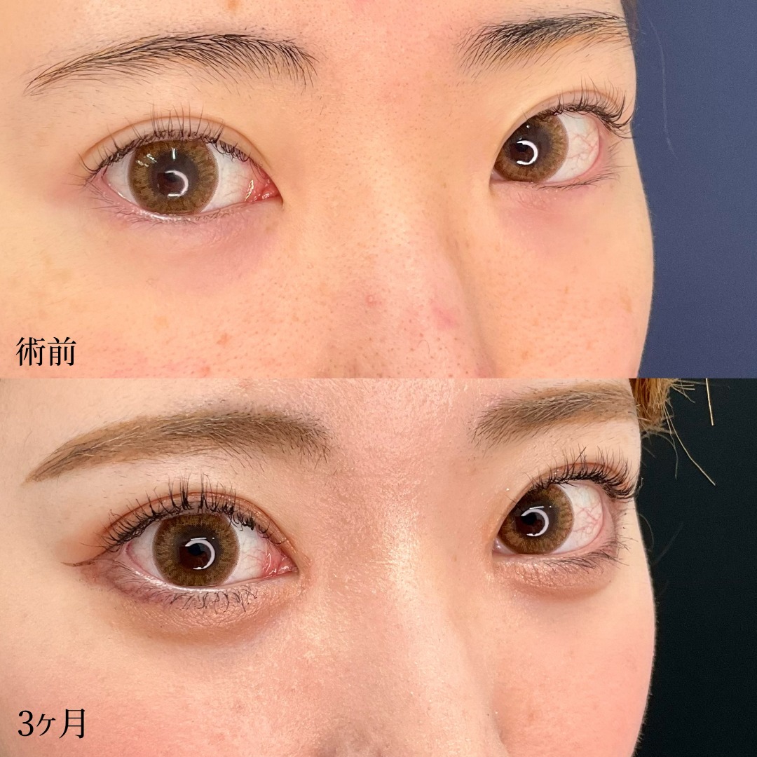 20代女性の目頭切開の症例