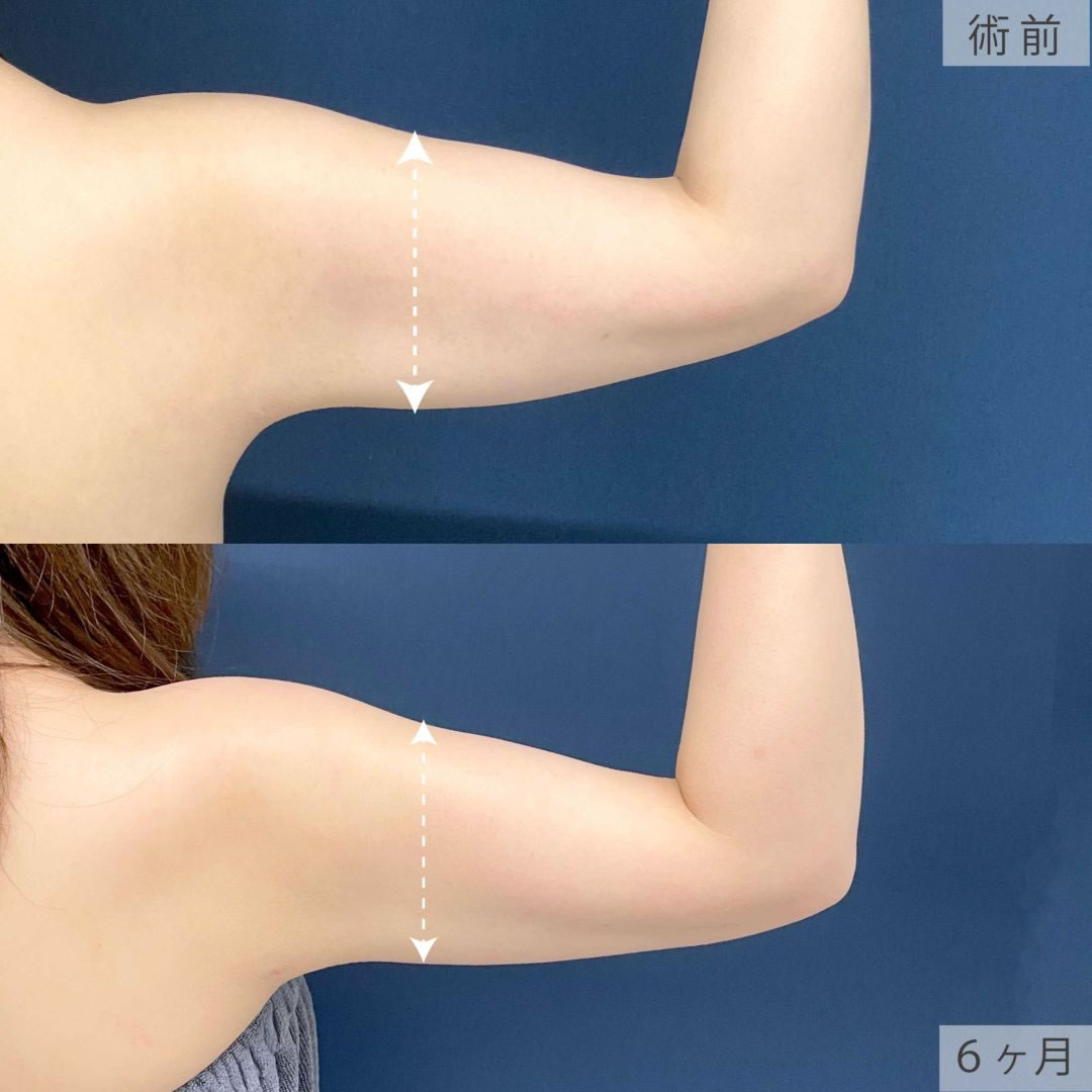 アキーセル脂肪吸引で二の腕と肩が細くなった３０代女性の症例