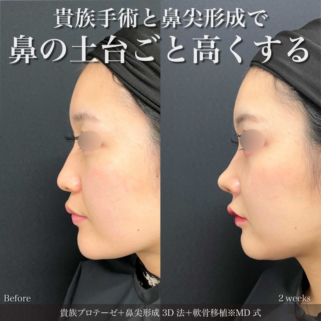 貴族手術と鼻尖形成3D法をMD式で受けた女性の症例写真