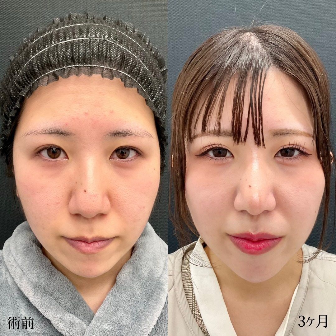 20代女性の鼻尖形成の症例