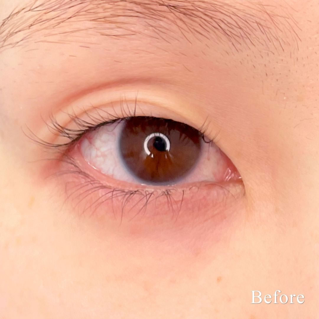 二重埋没法と眼瞼下垂の拡大症例写真