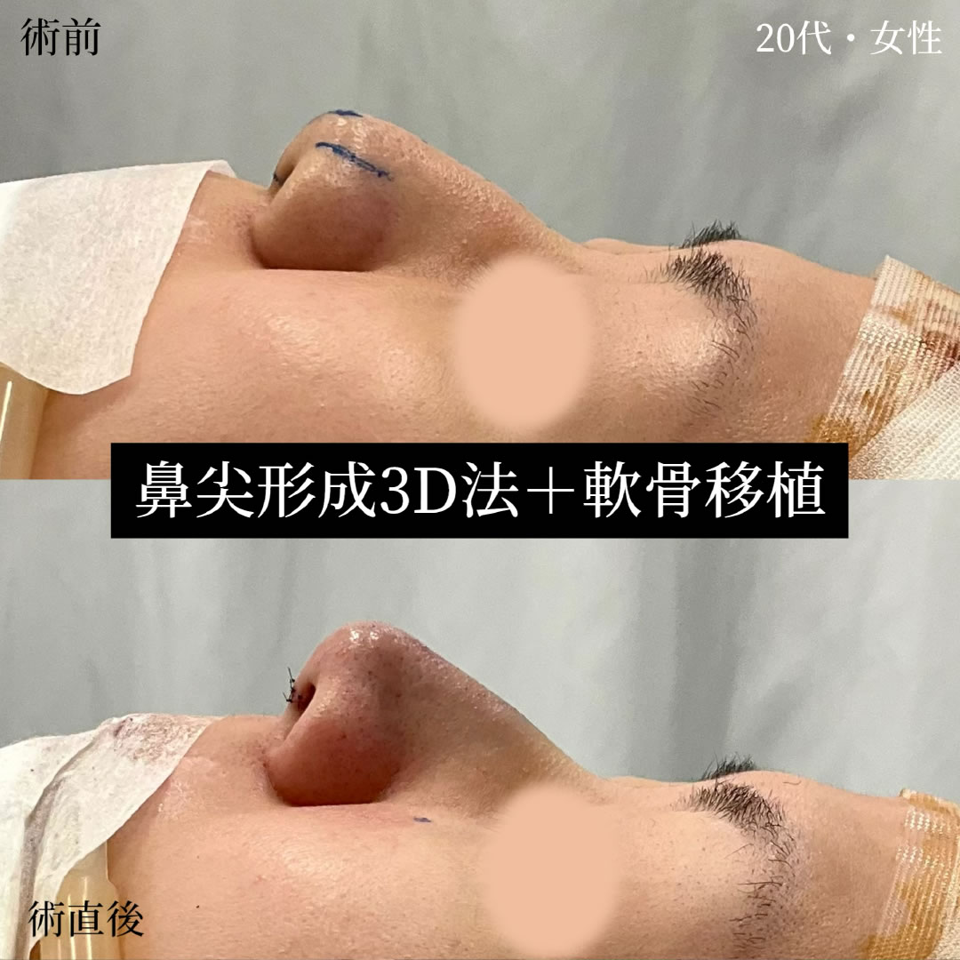 20代女性の鼻尖形成と軟骨移植の症例