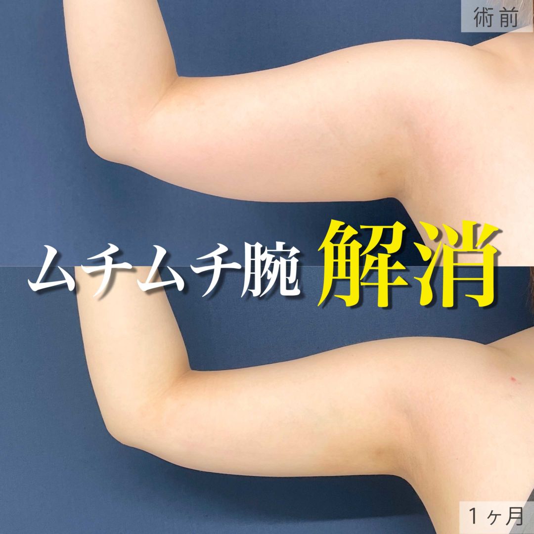 二の腕と肩のアキーセル脂肪吸引の１ヶ月の症例