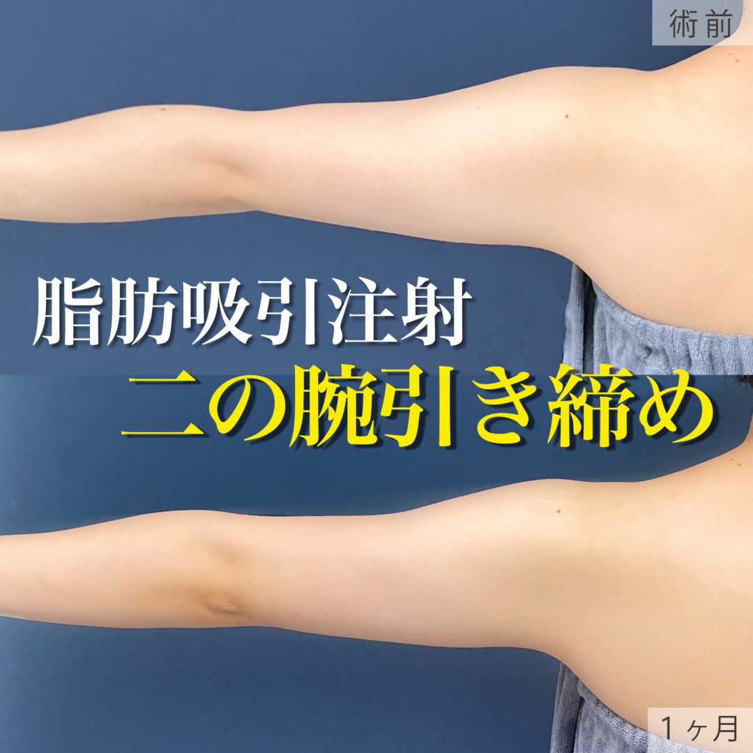 二の腕の脂肪吸引注射の１ヶ月目の症例