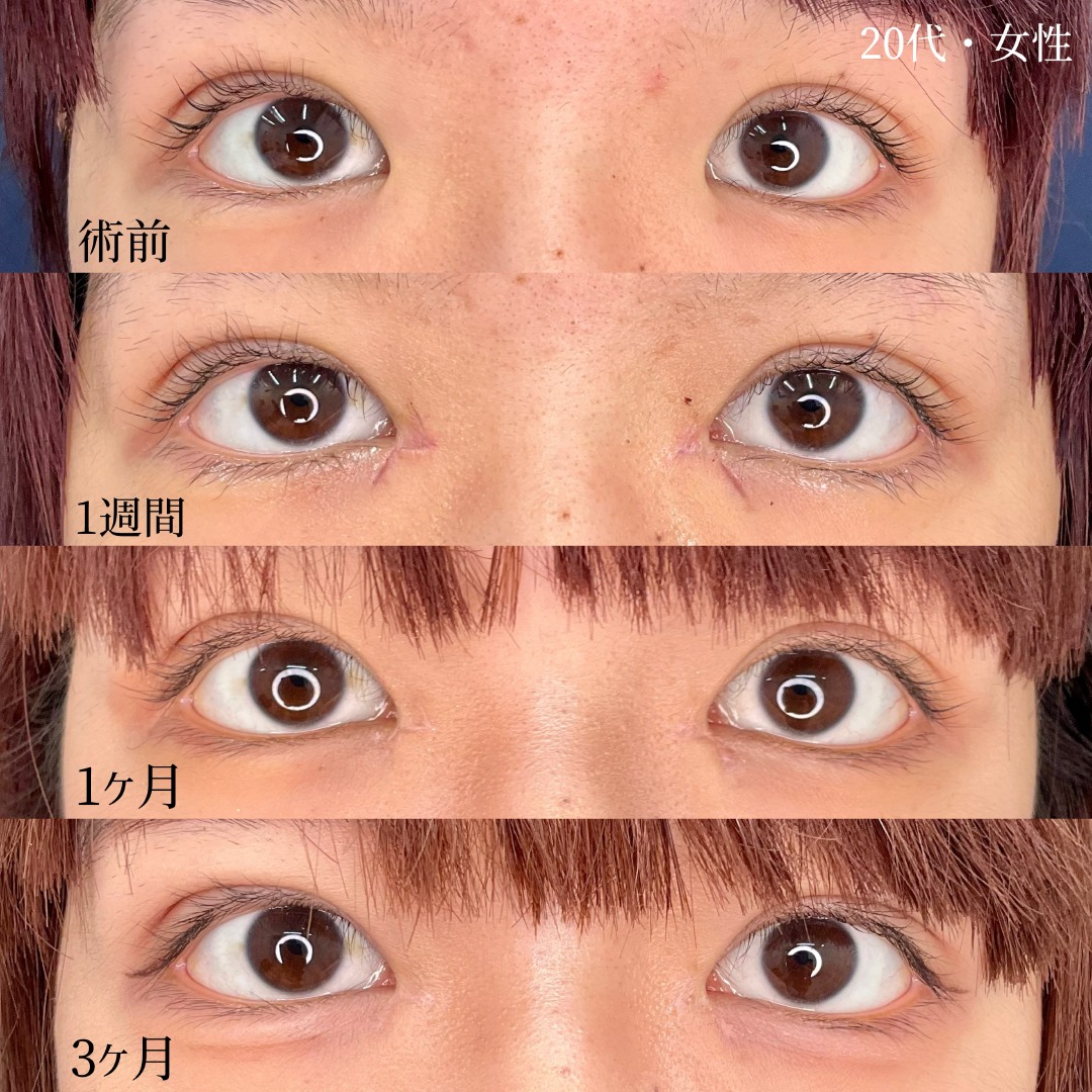 20代女性の目頭切開の症例