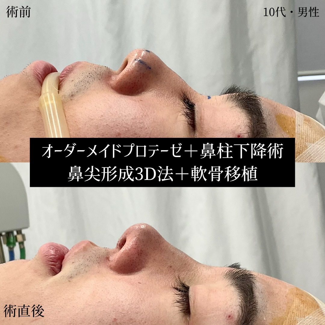 10代男性の鼻整形の症例