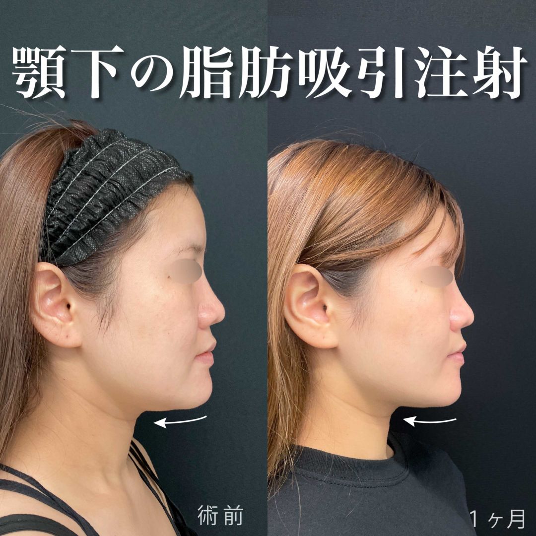 あご下の脂肪吸引注射の1ヶ月の症例写真