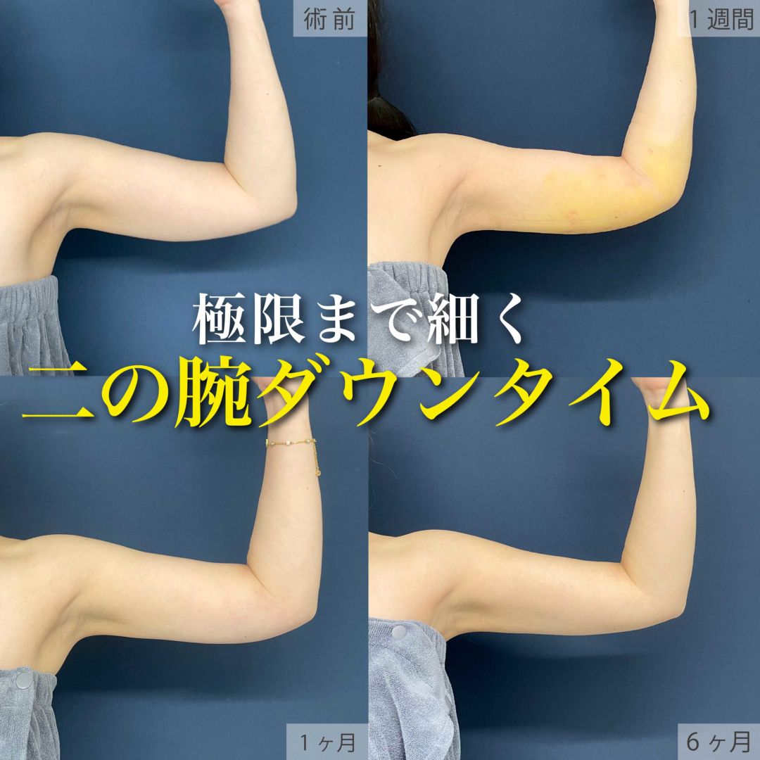 二の腕と肩のアキーセル脂肪吸引の６ヶ月までのダウンタイム
