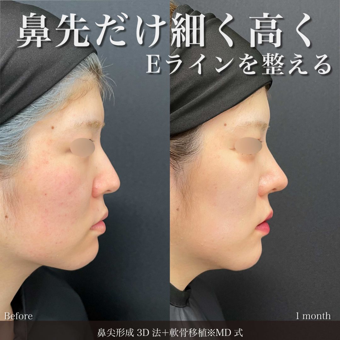 鼻尖形成3D法と軟骨移植をMD式で受けた女性の症例