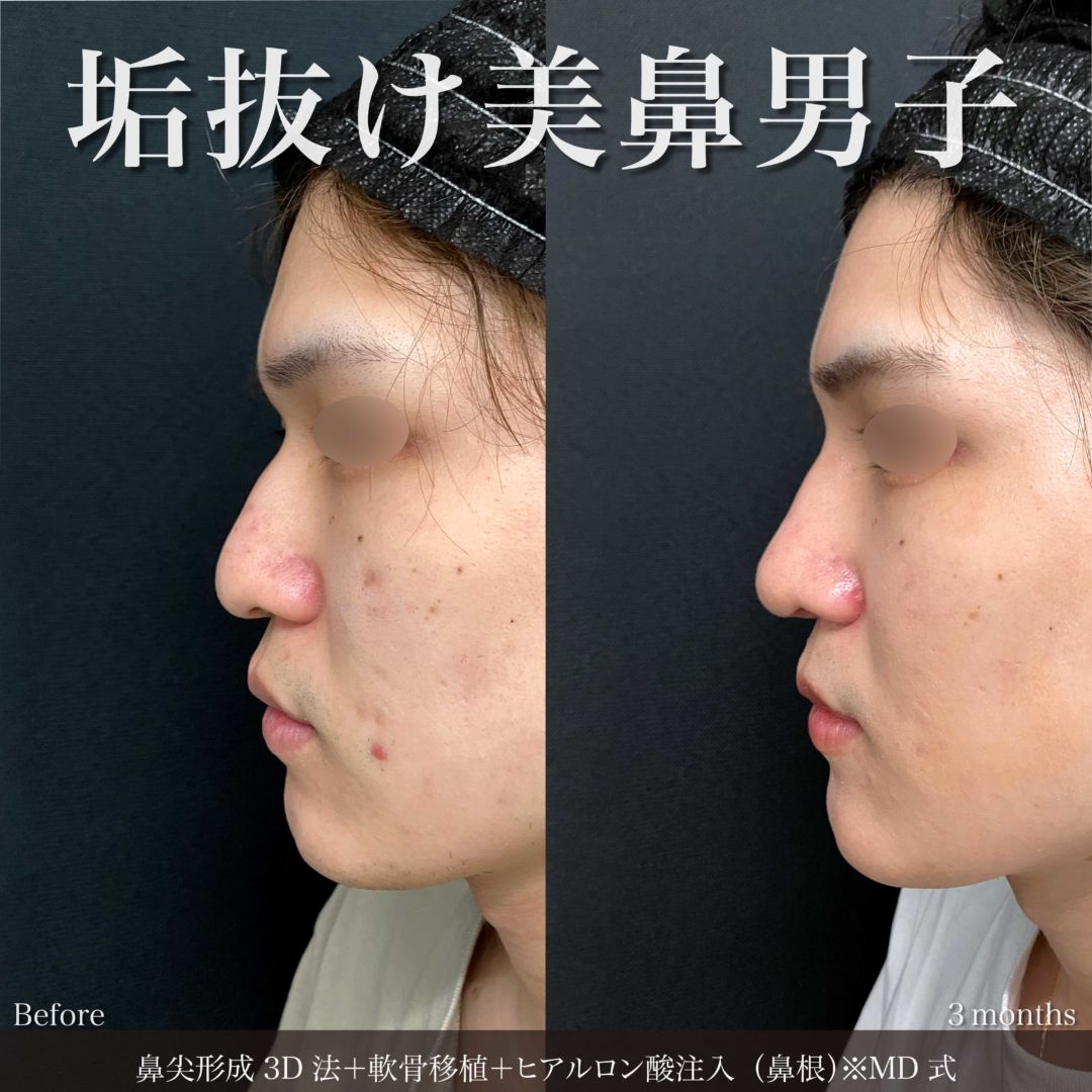 鼻尖形成3D法＋軟骨移植＋ヒアルロン酸注入（鼻根）MD式で受けた男性の症例
