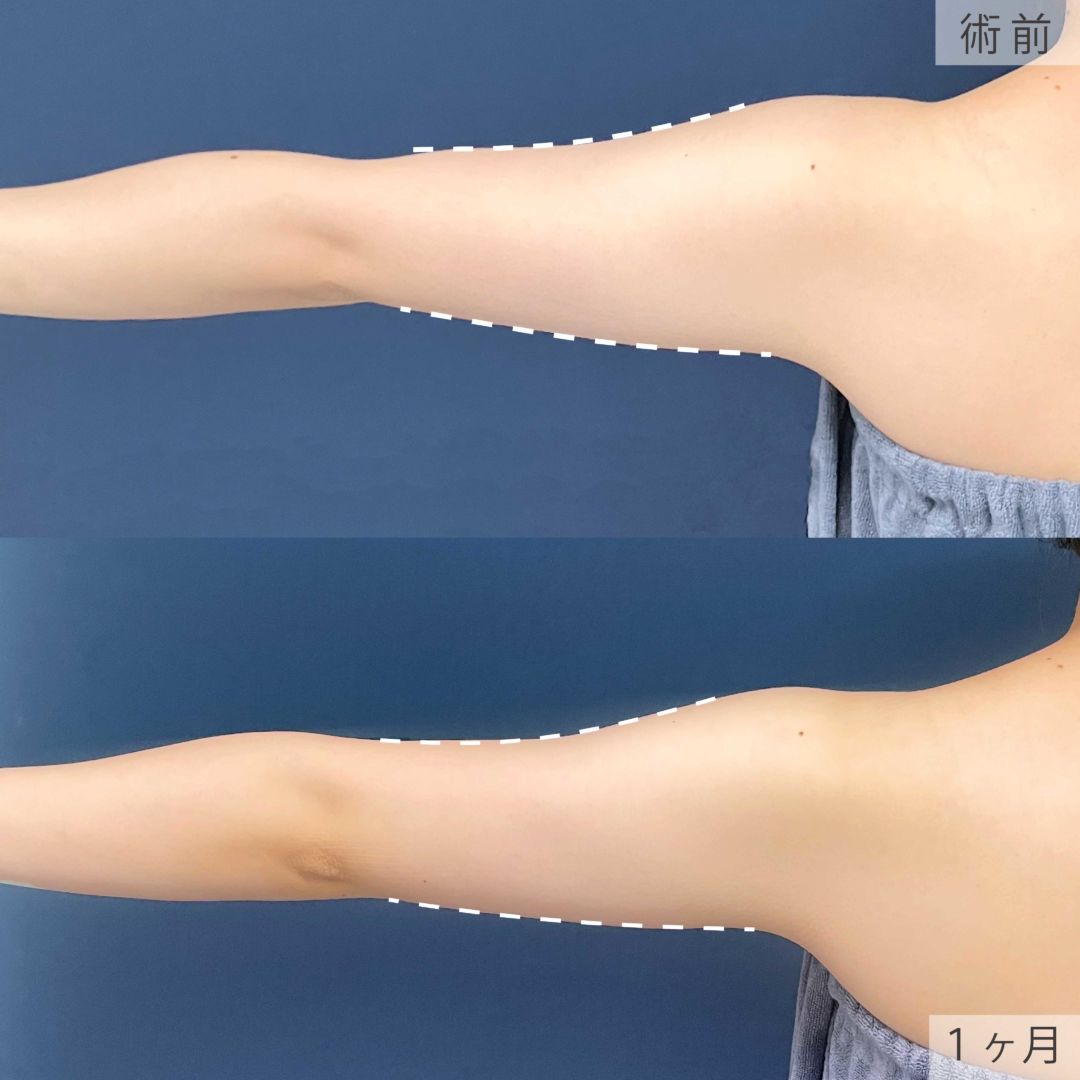 二の腕の脂肪吸引注射の１ヶ月目の症例