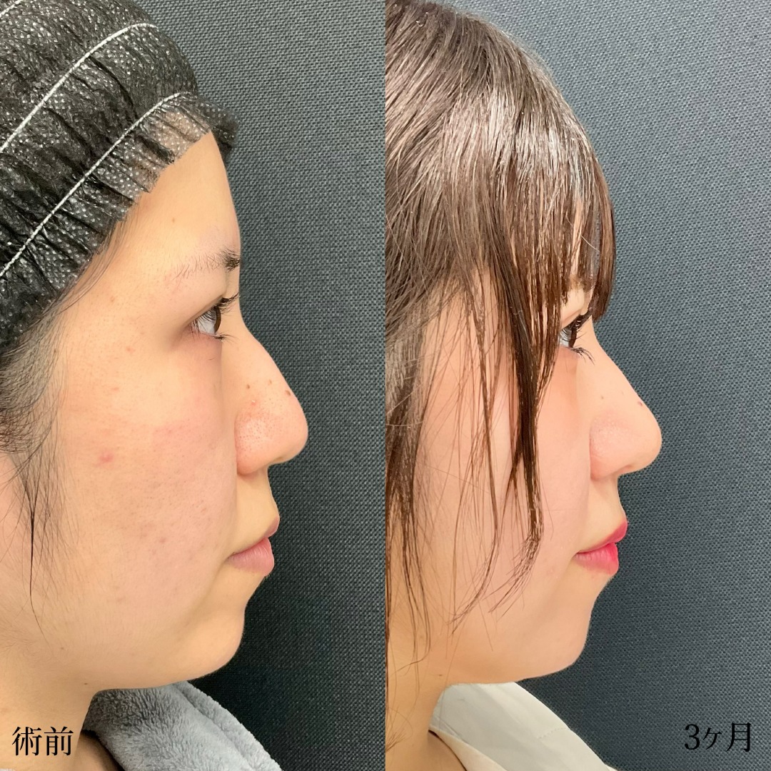 20代女性の軟骨移植の症例