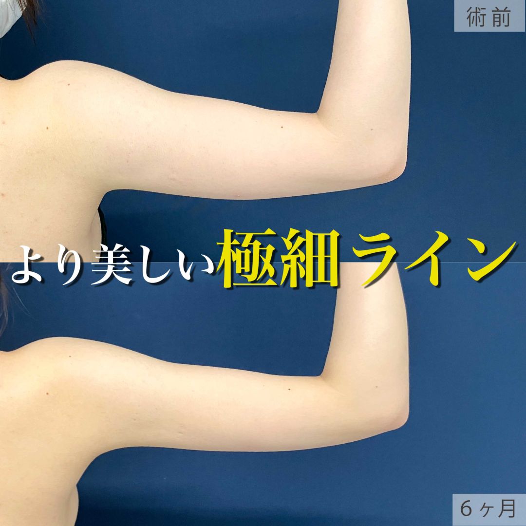アキーセル脂肪吸引で二の腕と肩が細くなった20代女性の症例