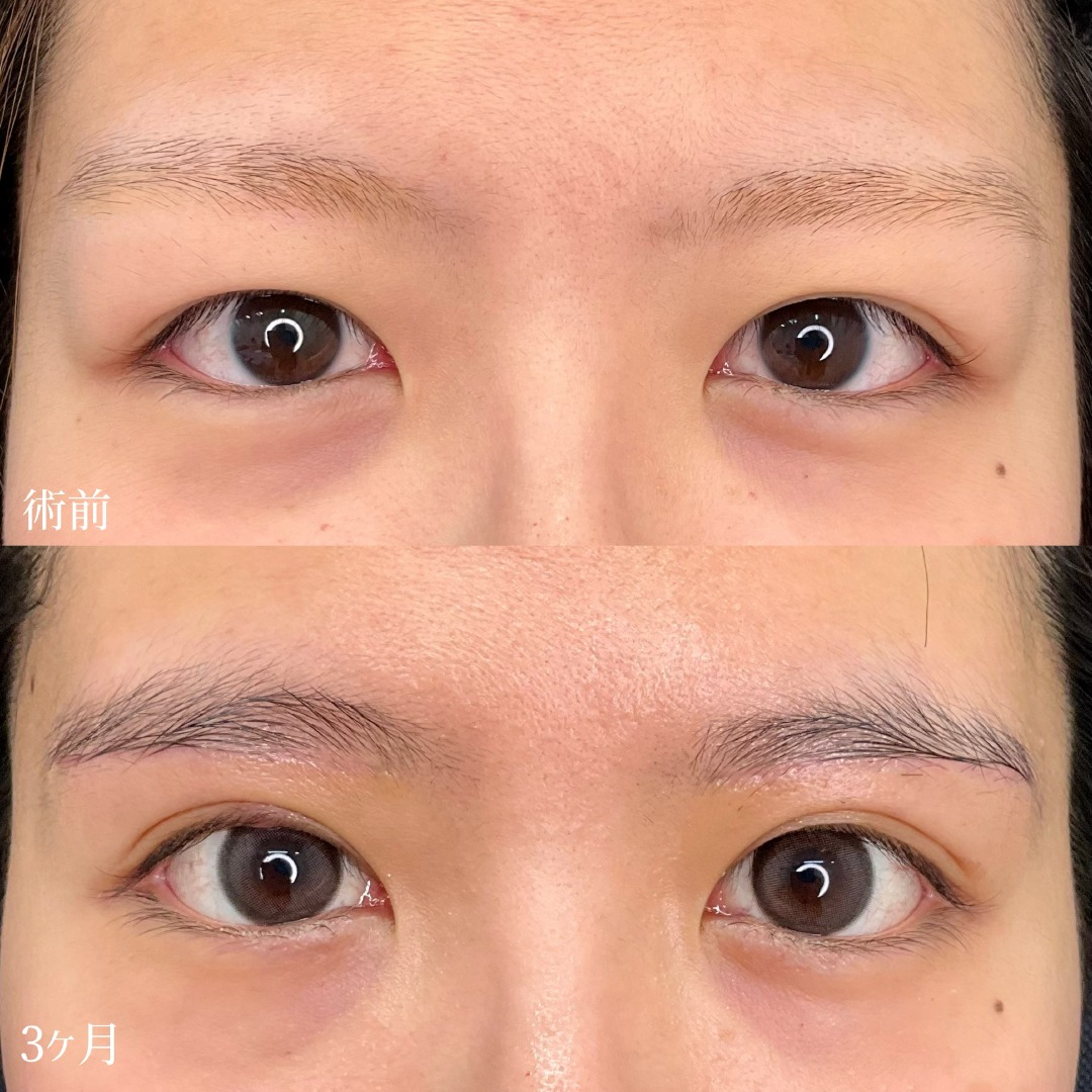 大宮の美容外科の眉下切開の症例