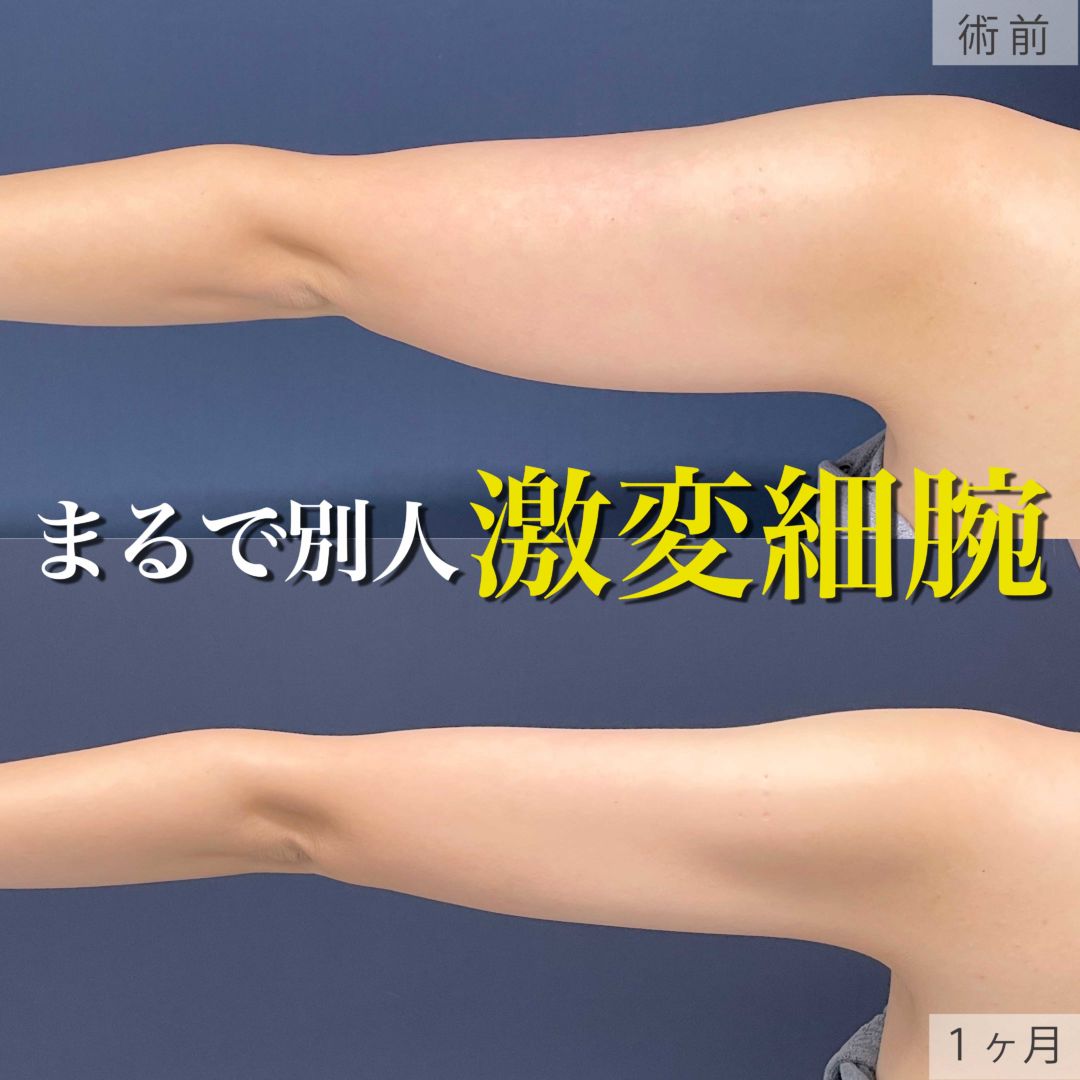 二の腕をアキーセル脂肪吸引した30代女性の１ヶ月目症例