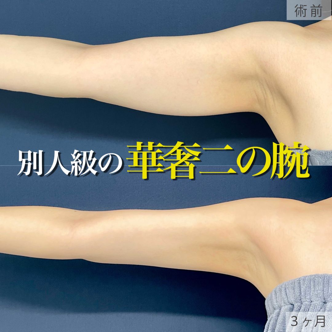 二の腕のアキーセル脂肪吸引で細くなった３ヶ月目の症例