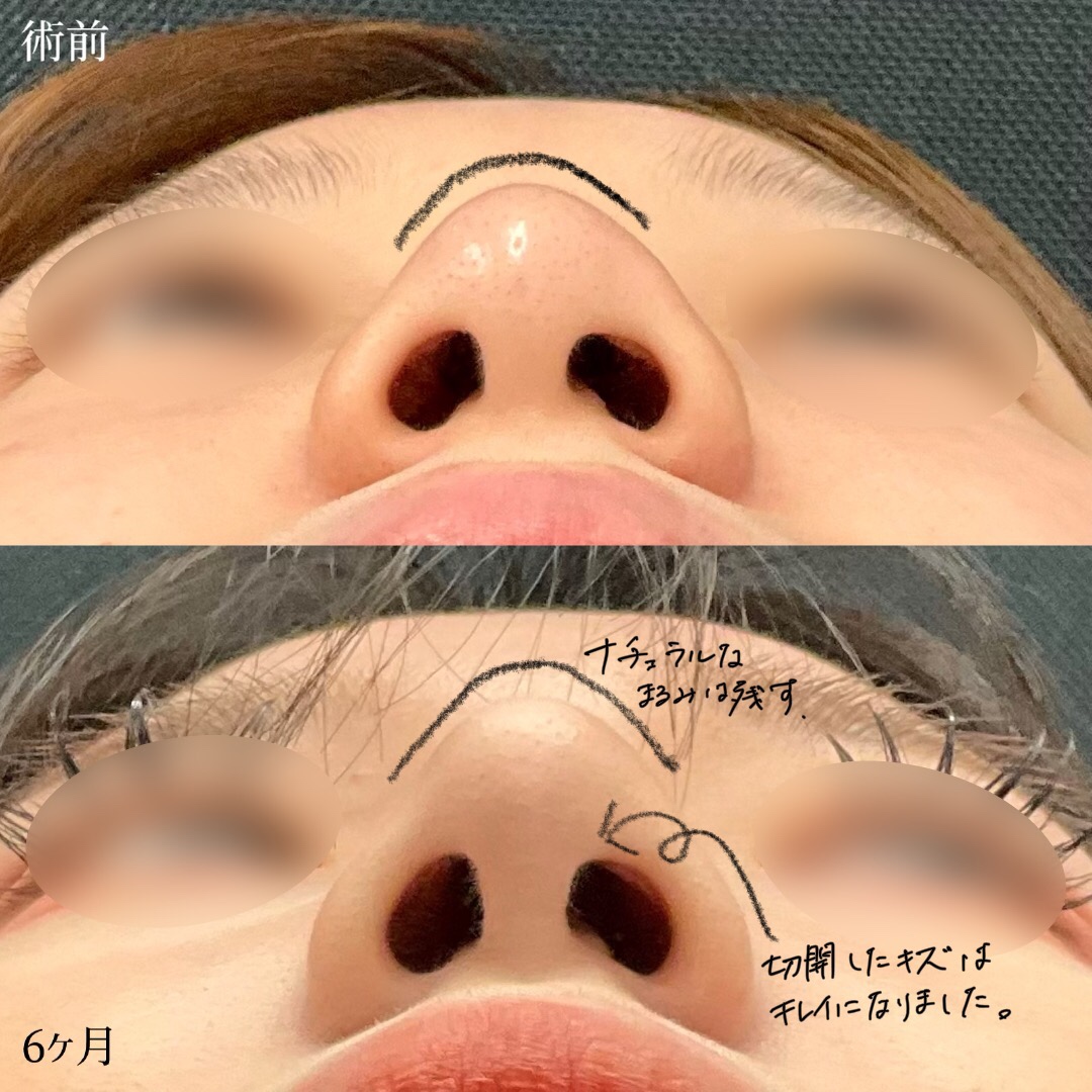 大宮の20代女性の鼻整形半年後の傷跡