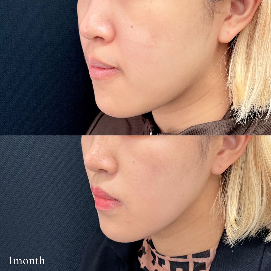 小顔脂肪吸引と糸リフトの術後1ヶ月後の症例写真