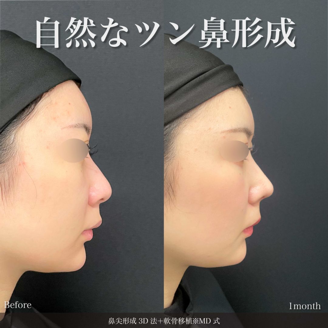 鼻尖形成 3D 法と軟骨移植※MD式の症例写真