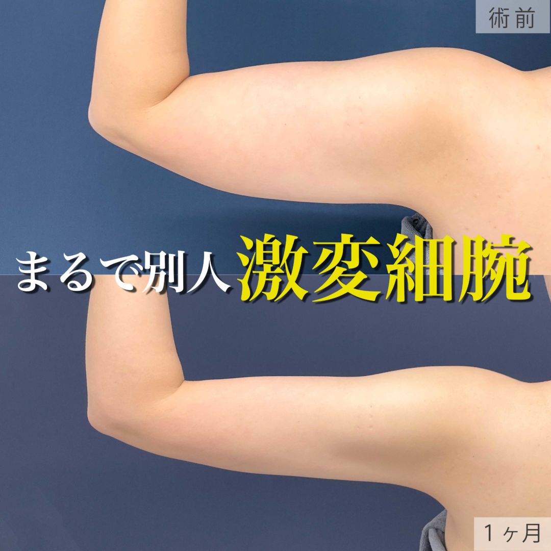 二の腕をアキーセル脂肪吸引した30代女性の１ヶ月目症例