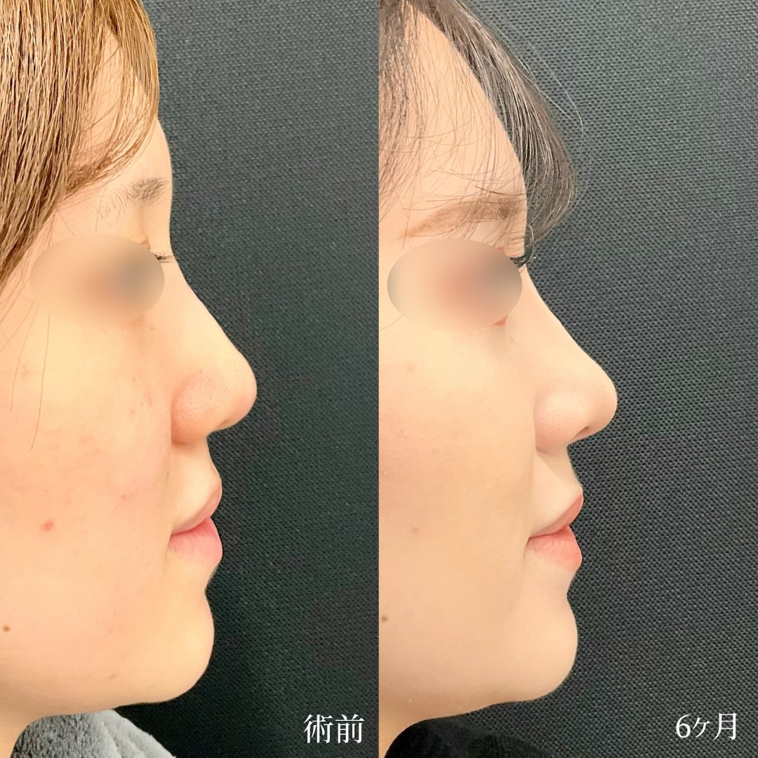 大宮の20代女性の鼻の他院修正の症例