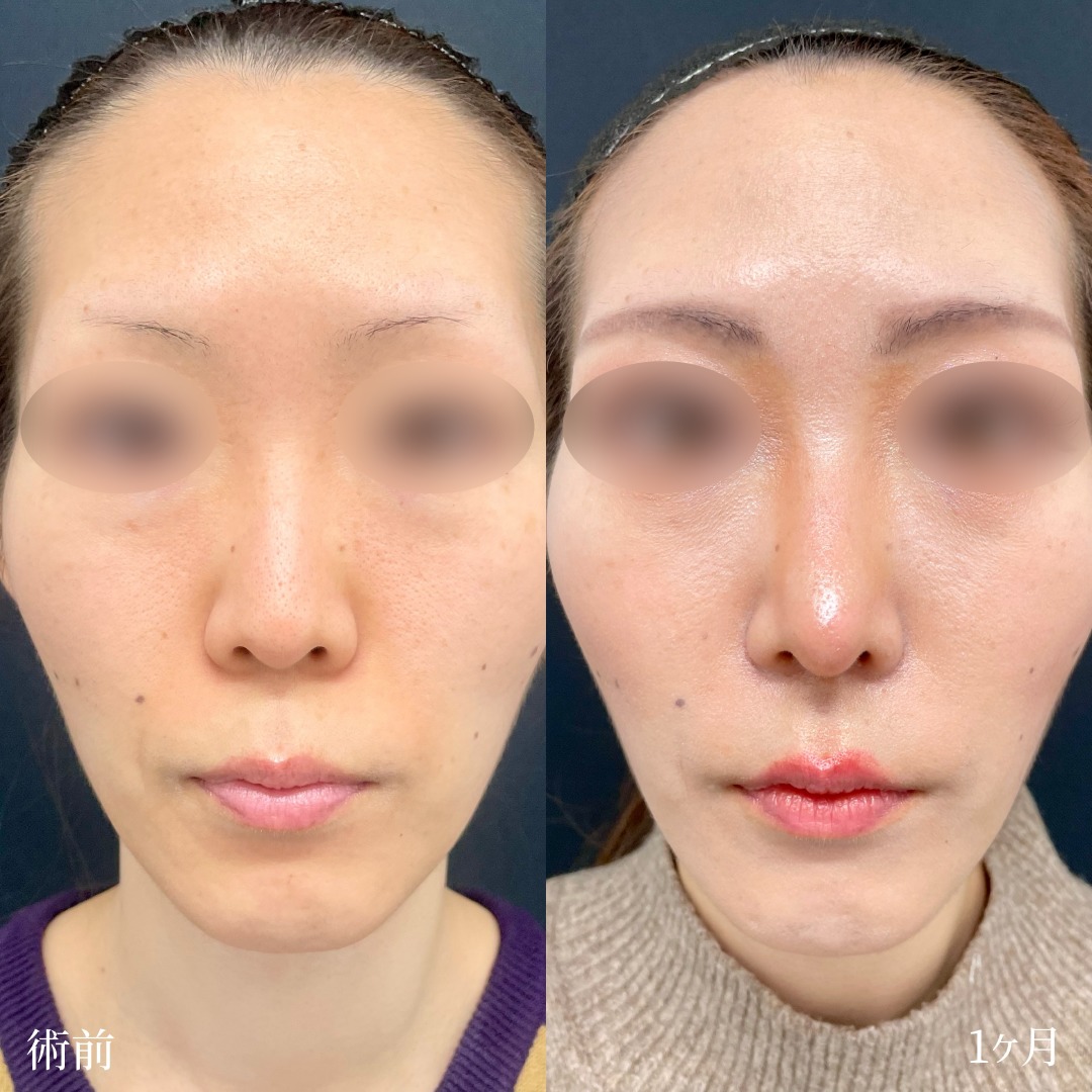 大宮の30代女性の鼻柱下降術の症例