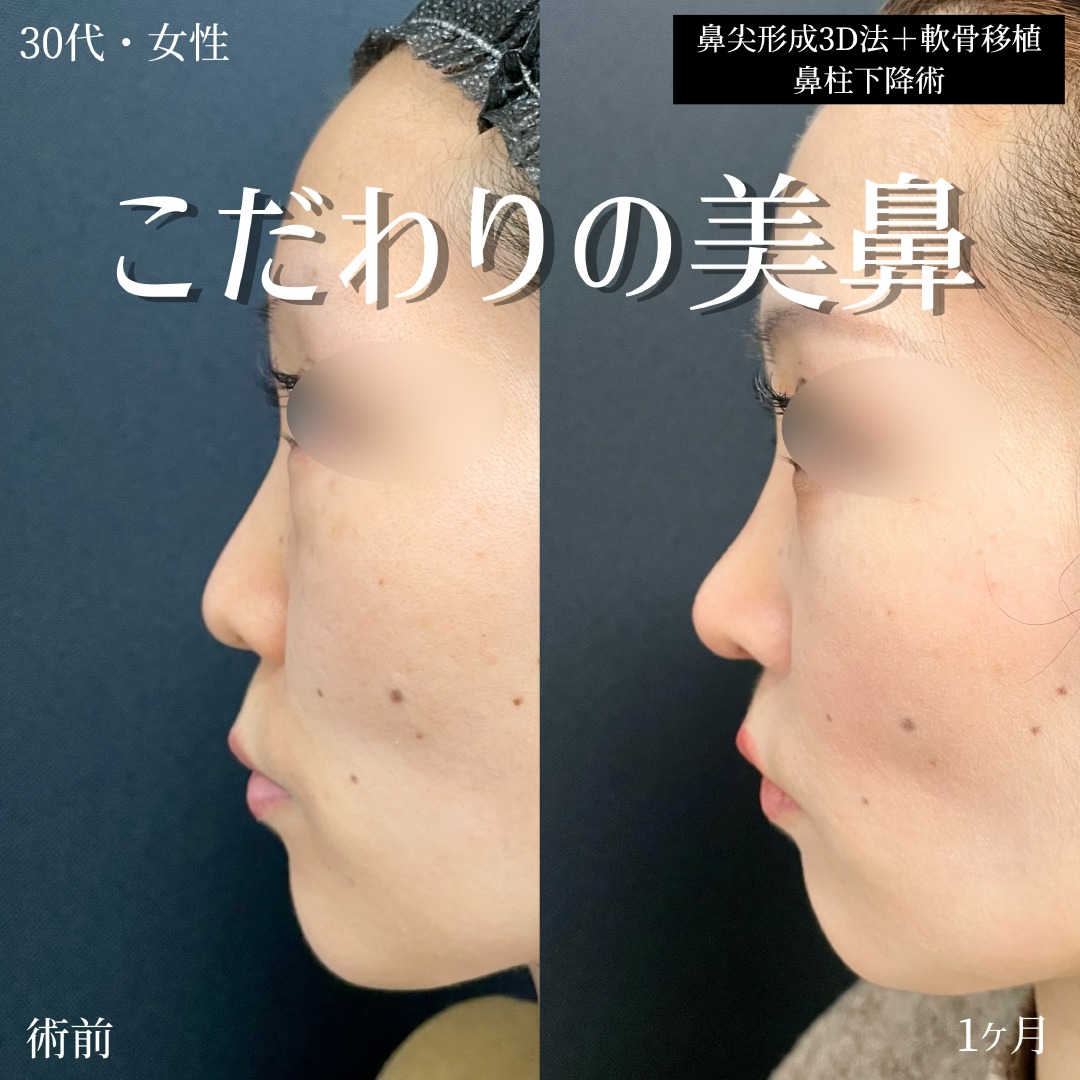 大宮の30代女性の鼻尖形成3D法の症例