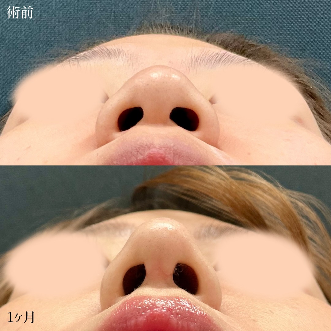 大宮の20代女性の鼻尖形成3D法と軟骨移植と小鼻ボトックスの症例
