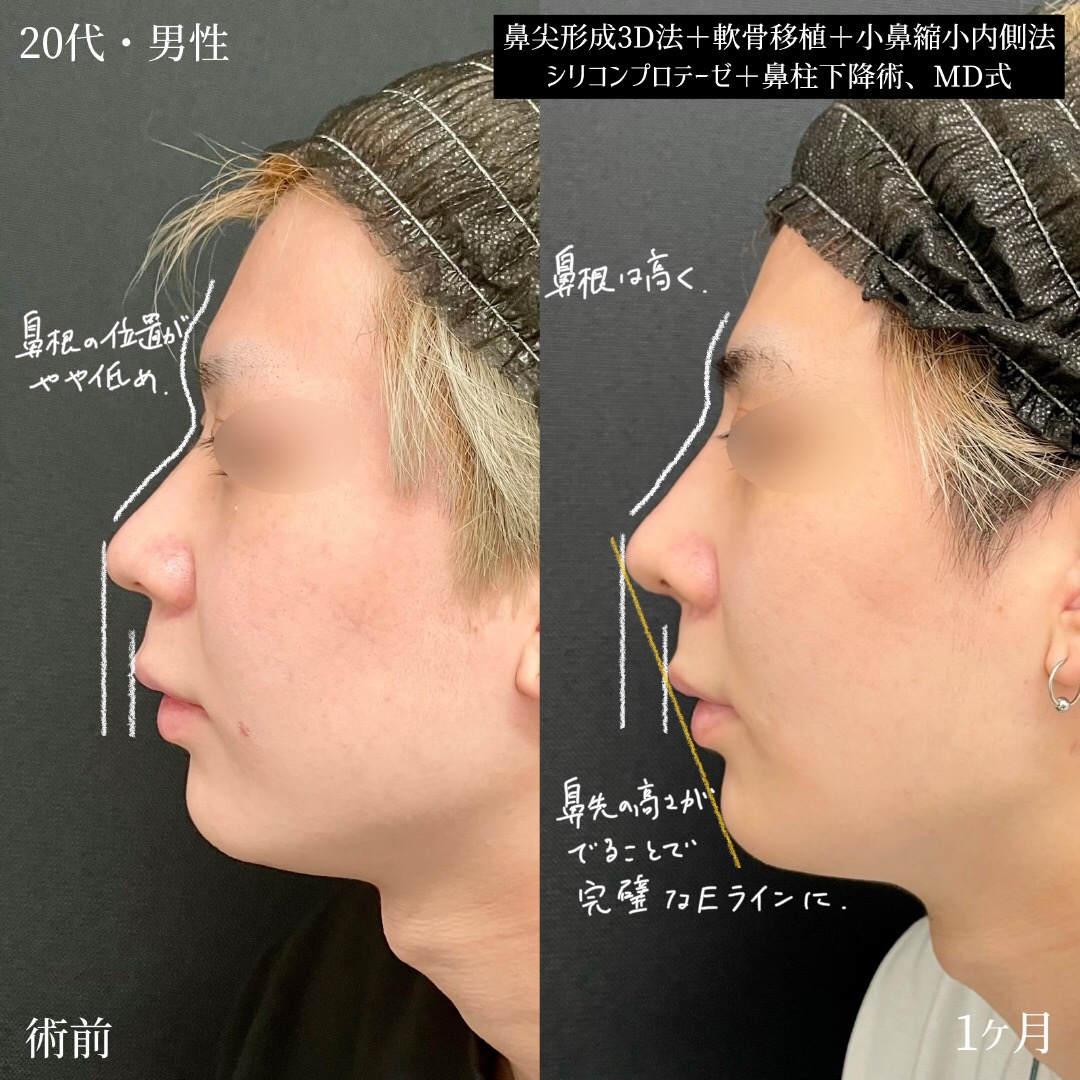 大宮の20代男性の鼻整形の症例