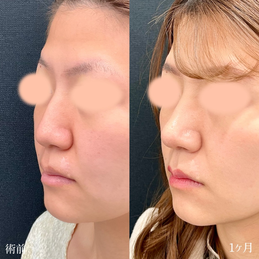 大宮の20代女性の鼻尖形成3D法と軟骨移植と小鼻ボトックスの症例