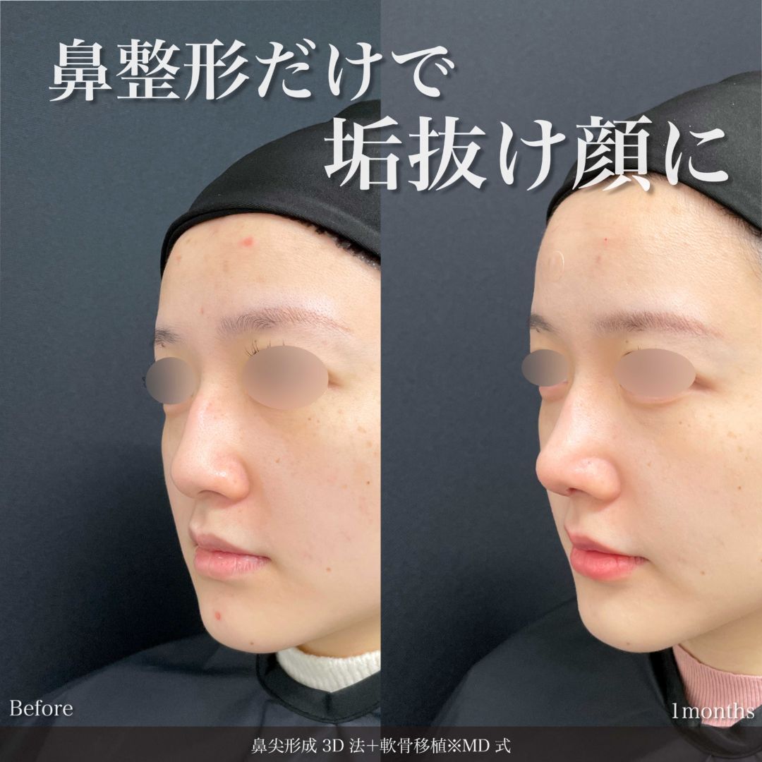 鼻尖形成 3D法と軟骨移植※MD式の症例写真
