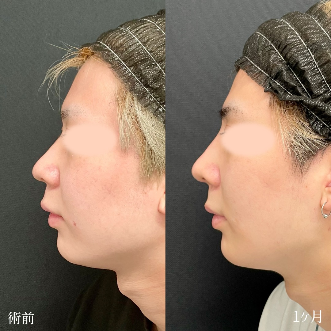 大宮の20代男性の鼻整形、鼻柱下降術の症例