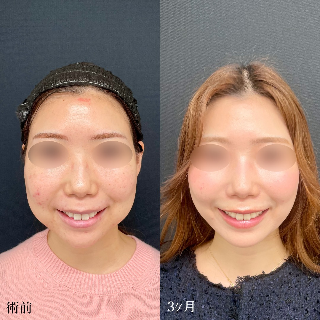 大宮の20代女性の小顔整形の症例