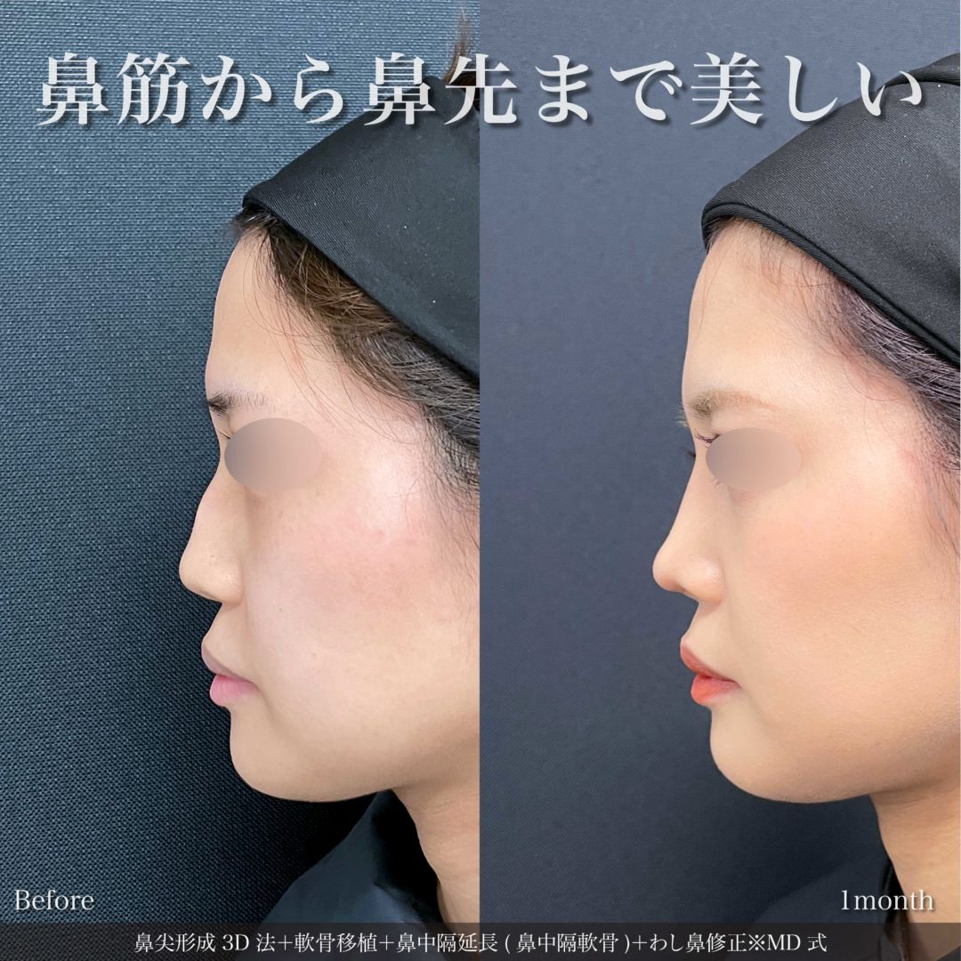 鼻尖形成3D法と軟骨移植と鼻中隔延長とわし鼻修正をMD式で受けた女性の症例