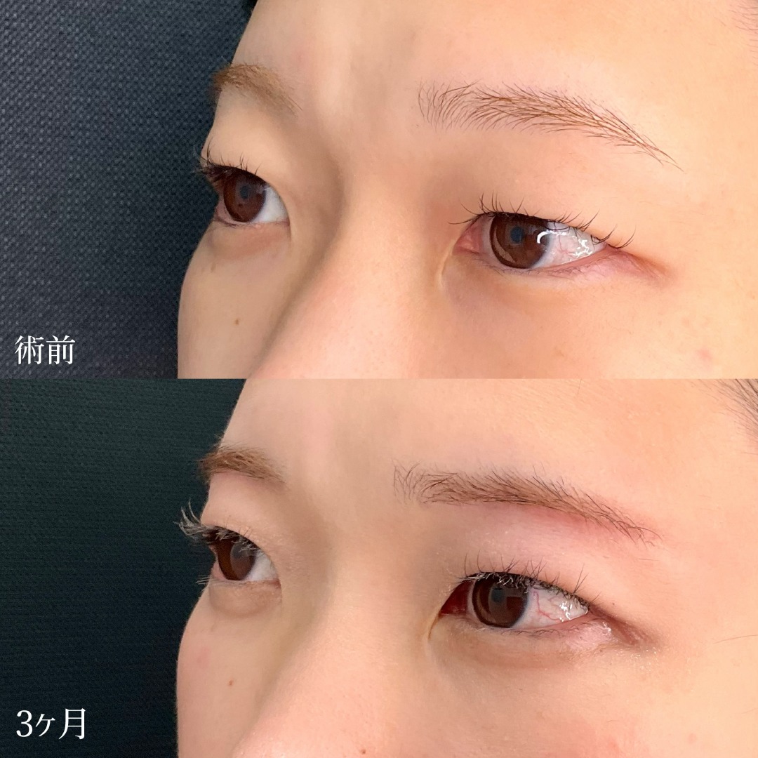 大宮の30代女性の眉下切開とROOF切除の症例
