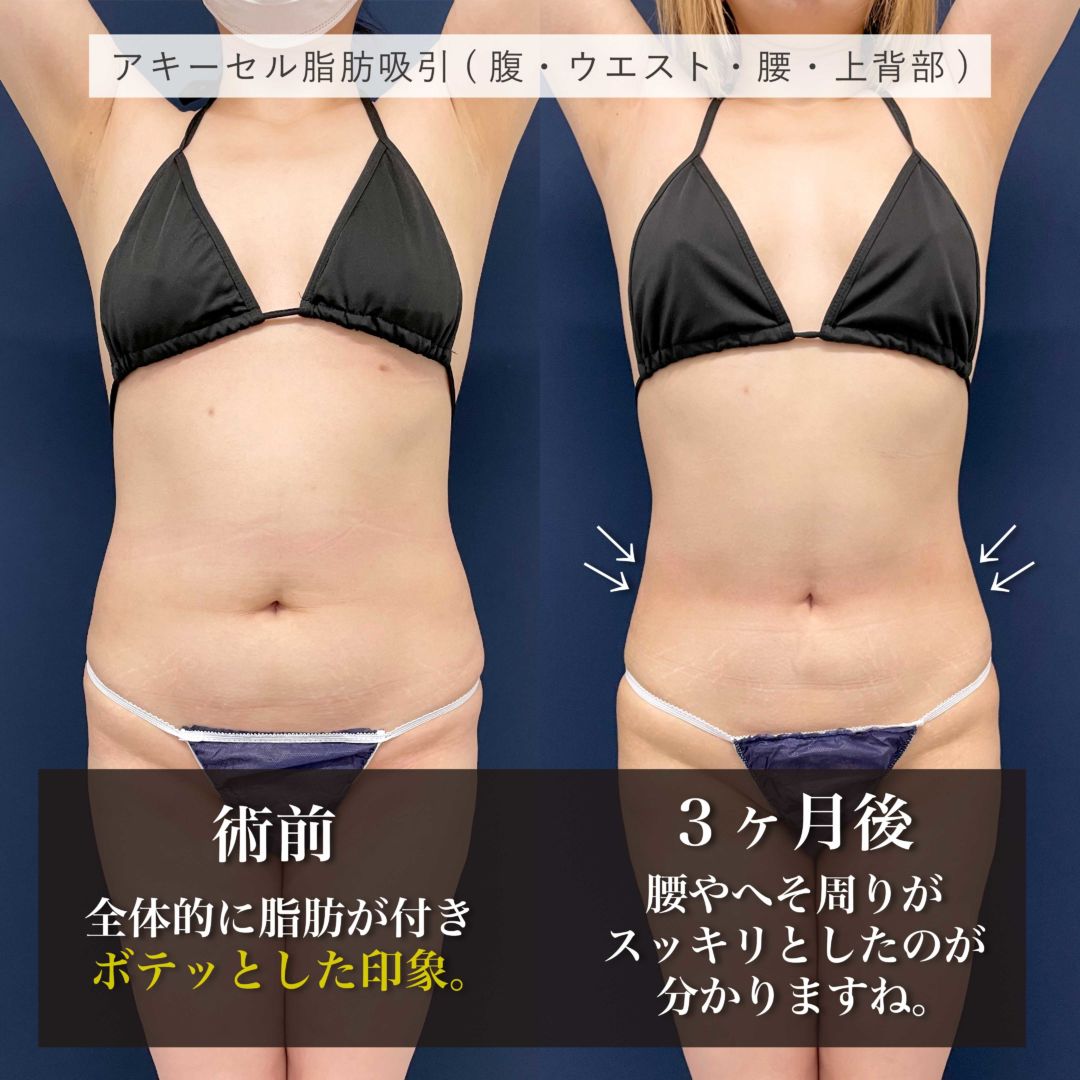 お腹と腰をアキーセル脂肪吸引で1800cc吸引した30代女性