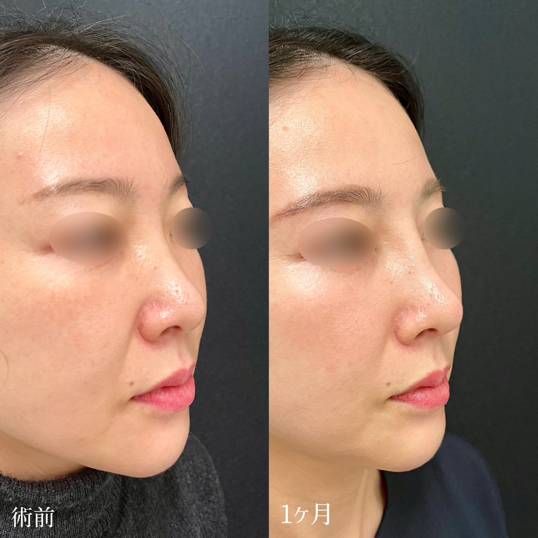 大宮の40代女性の鼻尖形成の症例