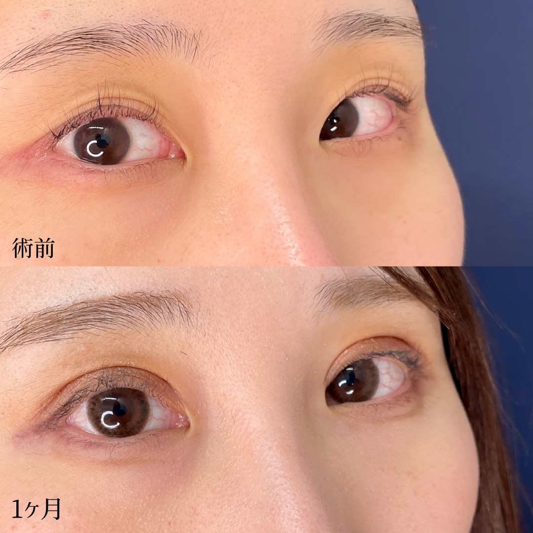 大宮の20代女性の眼瞼下垂の症例
