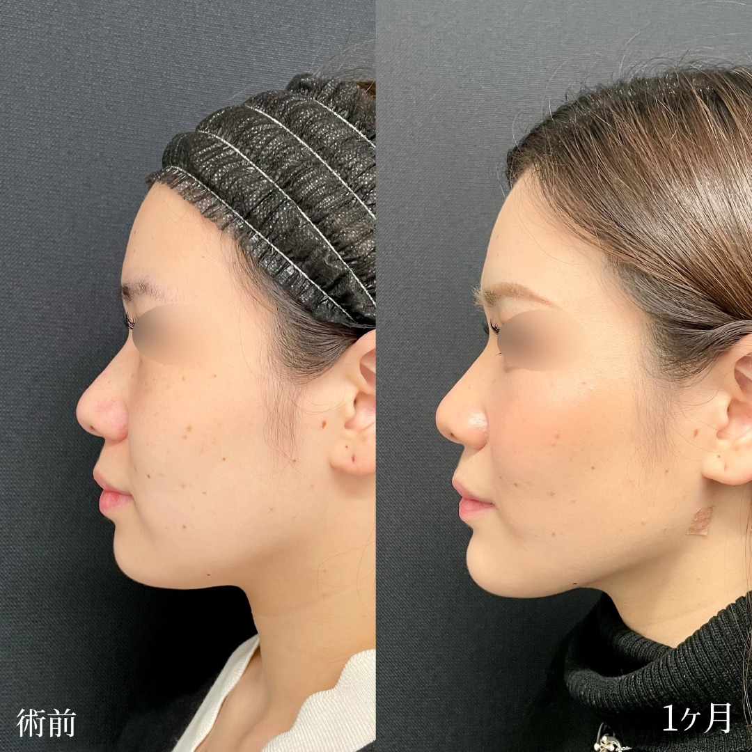 大宮の20代女性の顎ヒアルロン酸とあごボトックスの症例