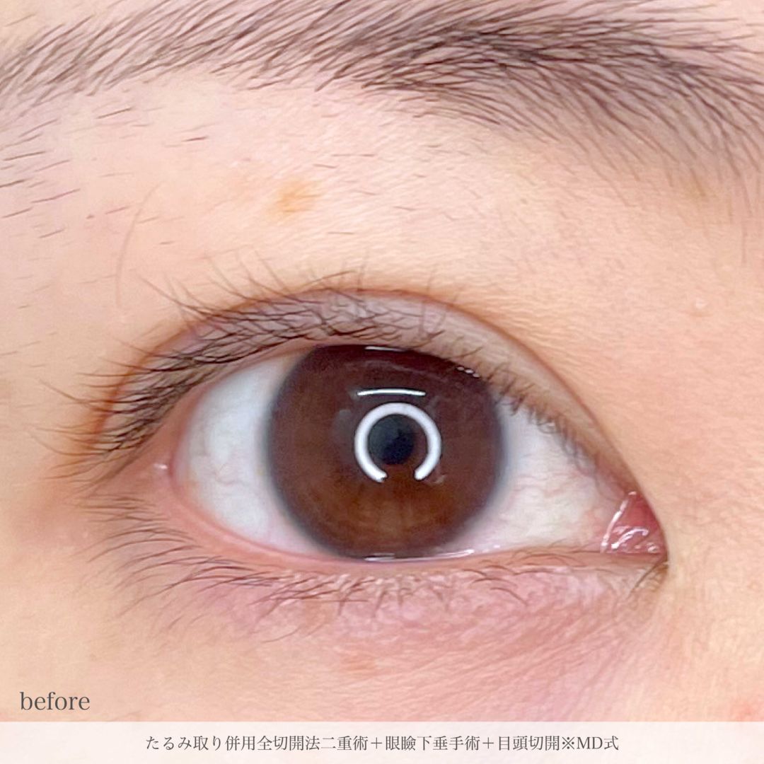 たるみ取り併用全切開法二重術と眼瞼下垂手術と目頭切開をMD式で受けた女性の症例