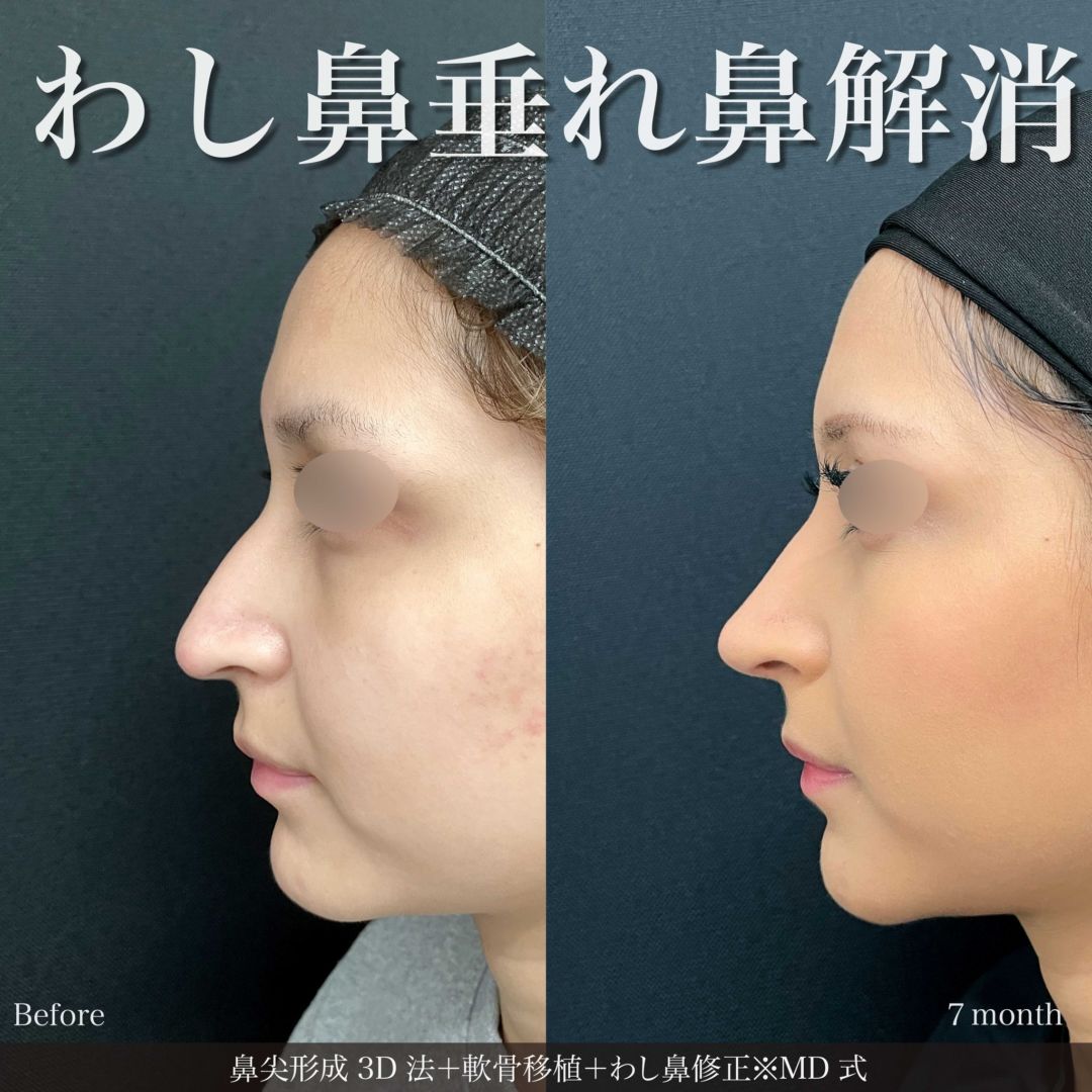 鼻尖形成3D法と軟骨移植とわし鼻修正※MD式の症例写真
