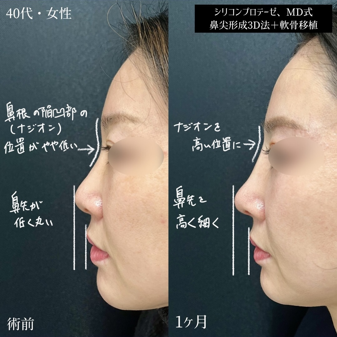 大宮の40代女性の鼻整形の症例