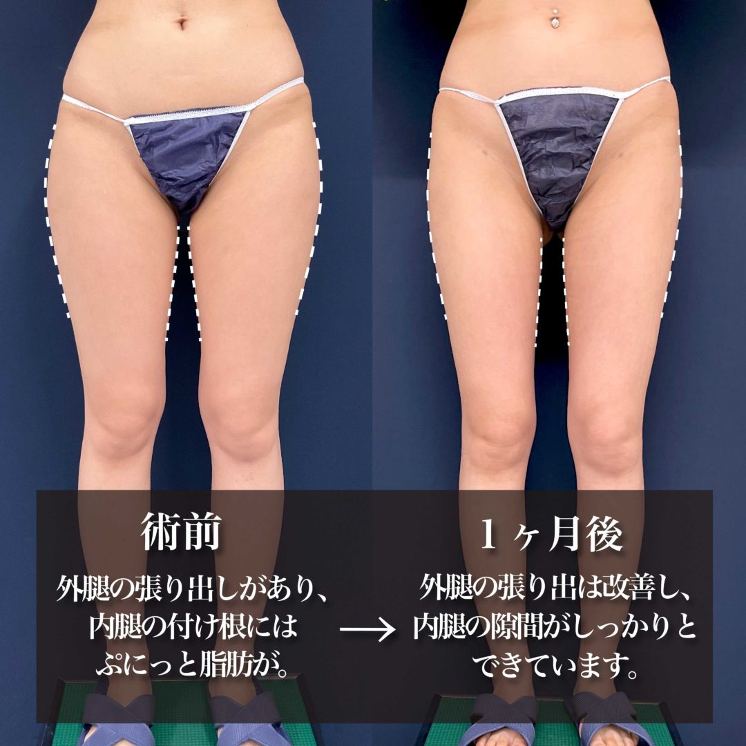 太ももの脂肪吸引で美脚になった20代女性の１ヶ月の症例