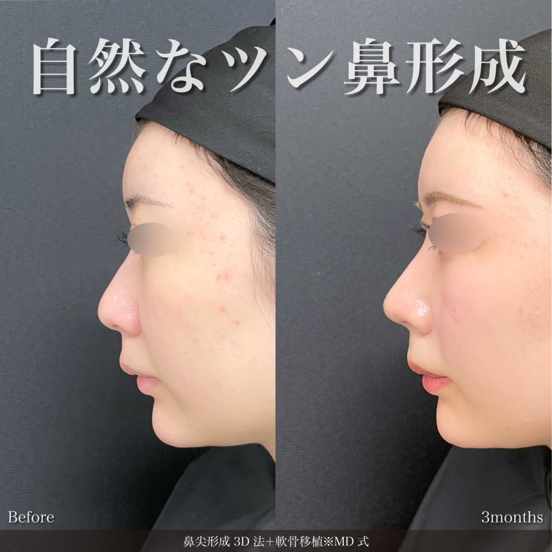 鼻尖形成3D法と軟骨移植をMD式で受けた女性の症例