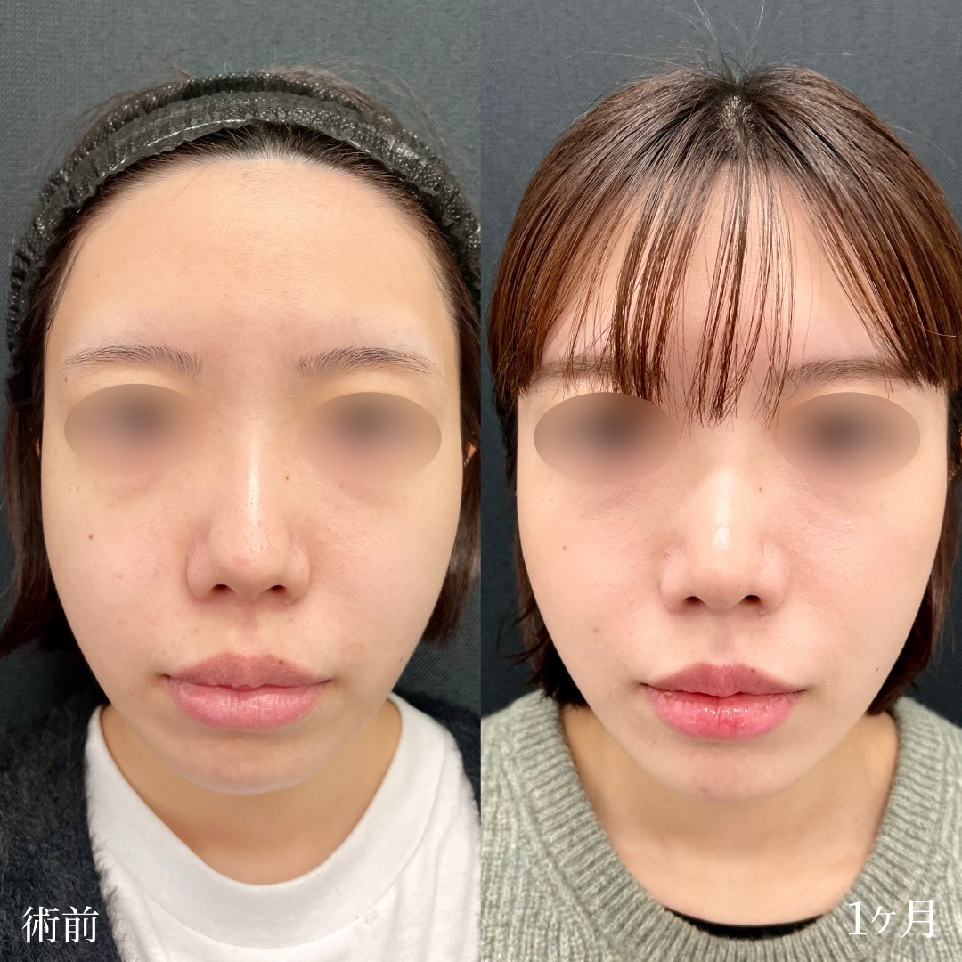 大宮の20代女性の鼻尖形成と軟骨移植の症例