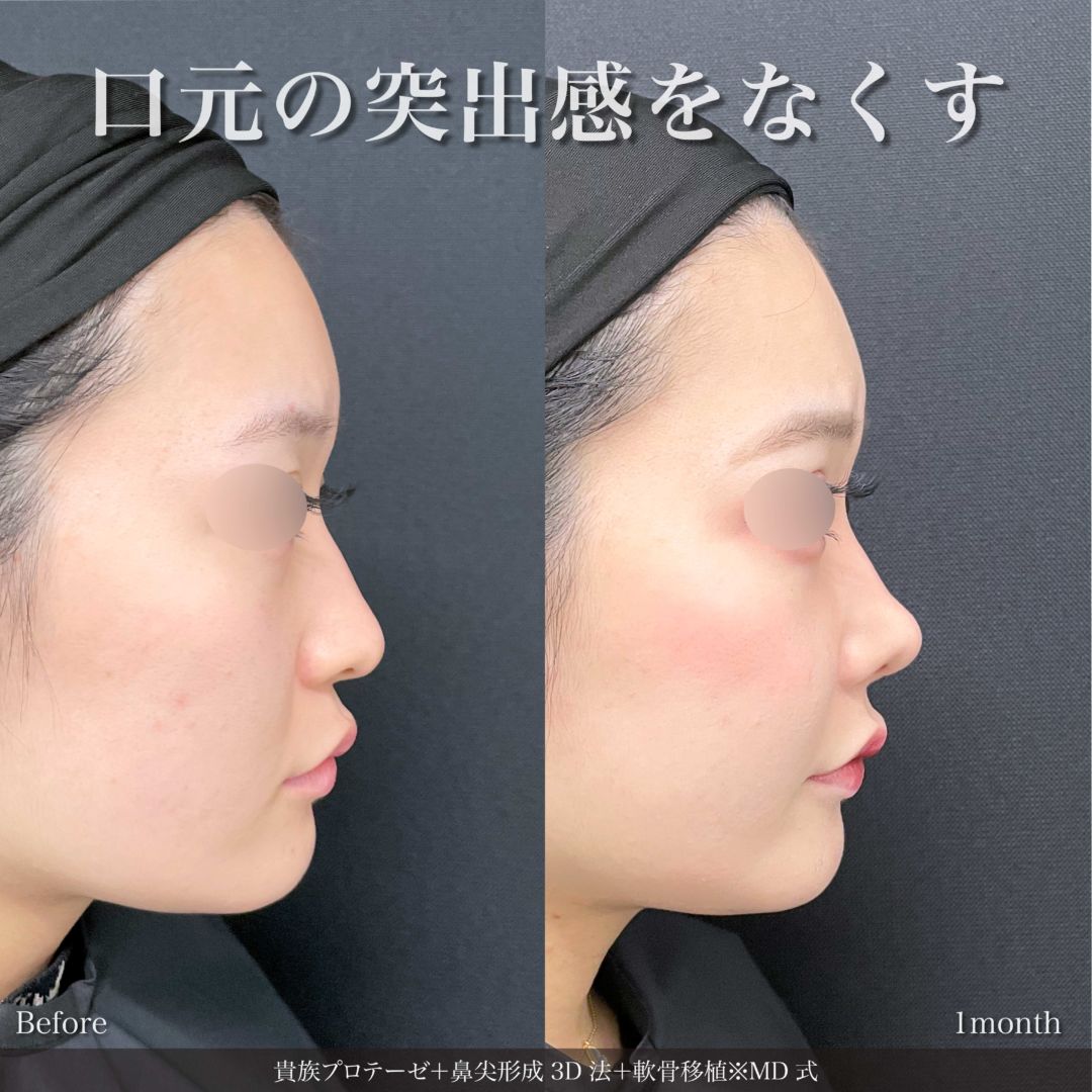貴族プロテーゼと鼻尖形成3D法と軟骨移植をMD式で受けた女性