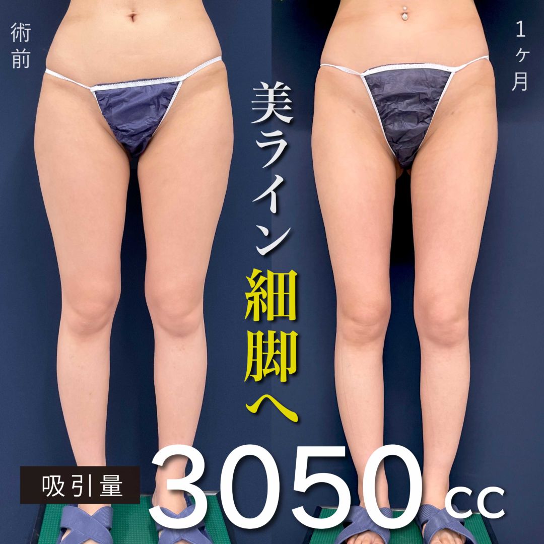 太ももの脂肪吸引で美脚になった20代女性の１ヶ月の症例