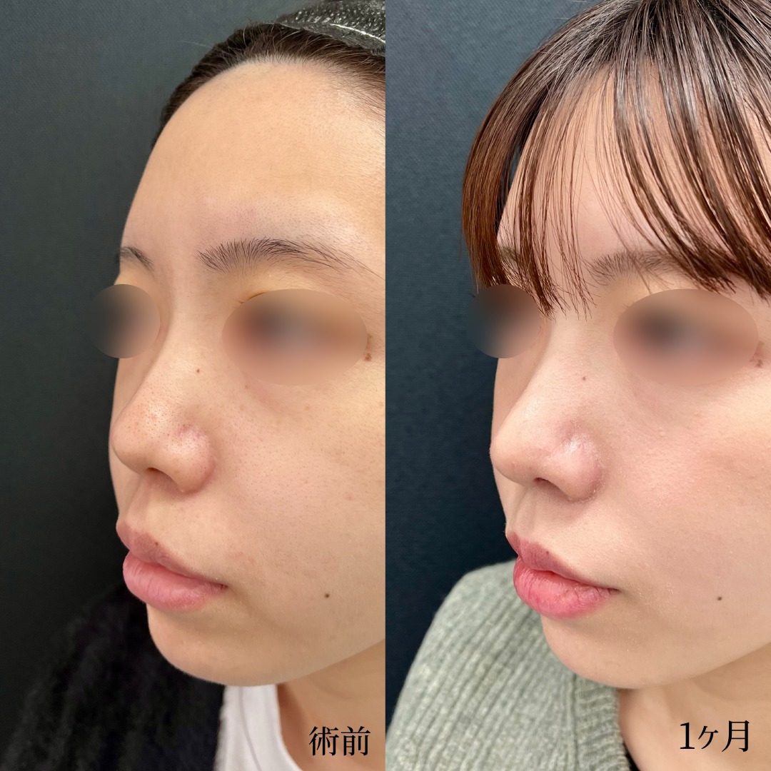 大宮の20代女性の鼻柱下降術の症例